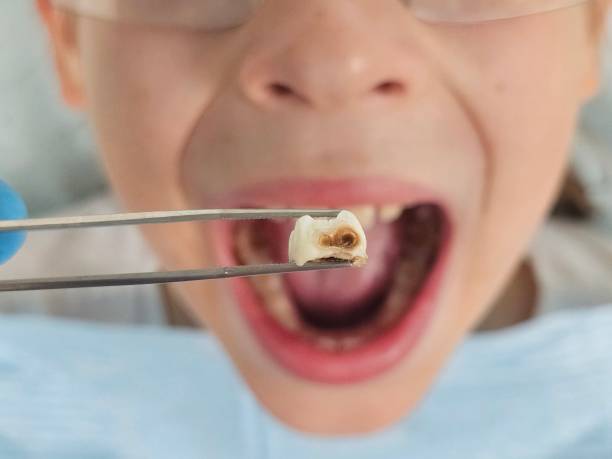 Best Emergency Dentist for Lost Fillings or Crowns in Greenacres, CA
